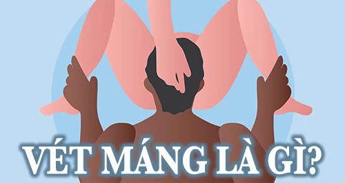 Vét máng là gì?